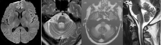 中枢神经脱髓鞘病是重大疾病吗,中枢神经系统脱髓鞘和多发性硬化