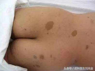 胎记按病因分为几类,胎记的原因及解决方法