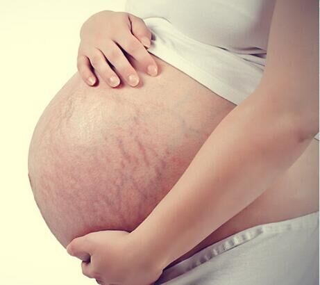 你比我更懂的妊娠纹的痛