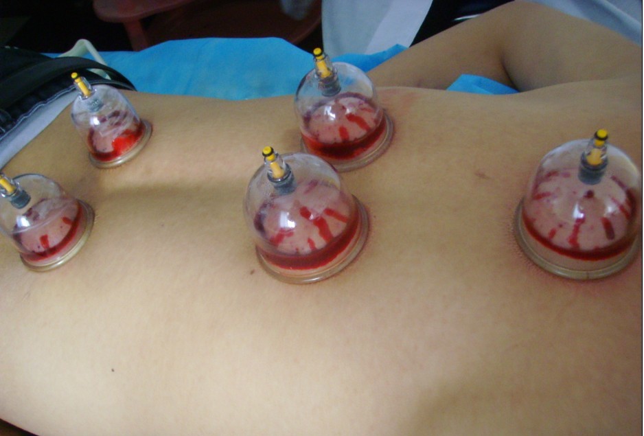 湿气重拔完火罐应该注意什么,能不能拔火罐祛湿毒