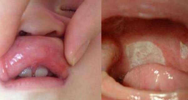 婴儿嘴巴里面有个洞怎么回事,宝宝嘴巴内壁有一个口子