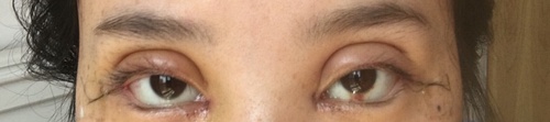 全切双眼皮疤痕增生多久可以恢复,全切双眼皮恢复过程经历真实