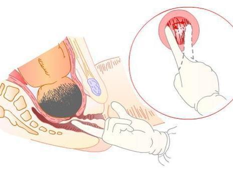 生孩子怎么开十指,女人生孩子开十指