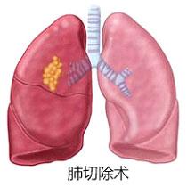 关于癌症你一定要知道的事,肺癌家属应该知道哪些问题