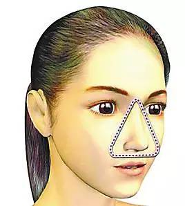 痘痘可以自己用针挤吗,痘可以挤吗