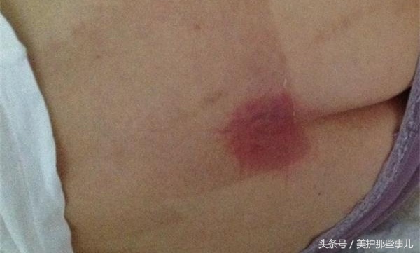 褥疮用酒精敷伤口行吗,用酒精消毒能治褥疮吗