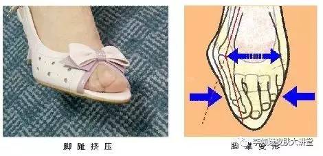 嵌甲自己剪出来就好了吗,嵌甲能修脚吗