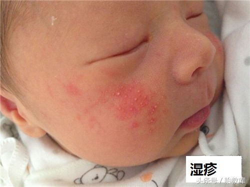婴儿湿疹要用什么方法去预防,婴儿湿疹怎么避免和预防