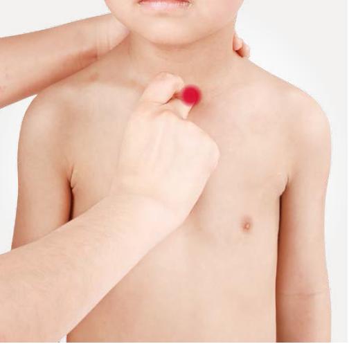 急性扁桃体炎按哪个穴位,急性扁桃体炎针灸哪个穴位