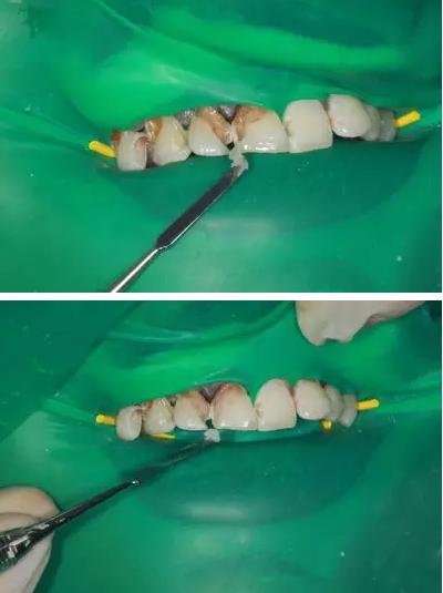 目前补救可乐牙最好的办法,可乐牙的治疗贵么