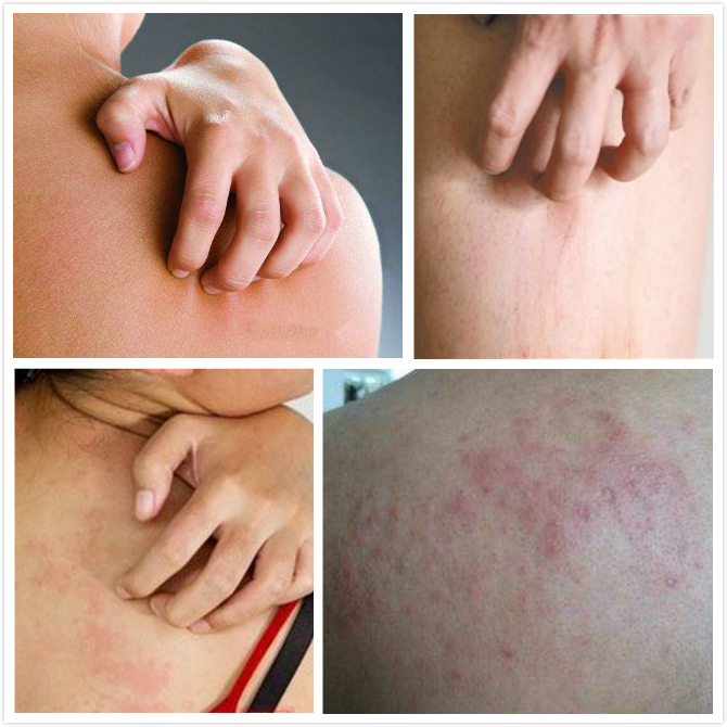 治皮肤瘙痒要怎么治,皮肤瘙痒警惕6种特效药