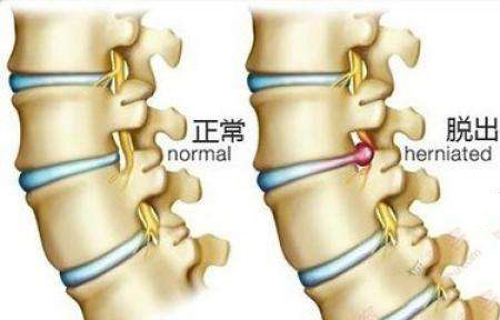 颈椎间盘曲度变直怎么办,颈椎间盘变直