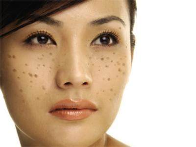 西南医院激光祛斑会反弹吗,皮秒激光祛斑反弹会更严重吗