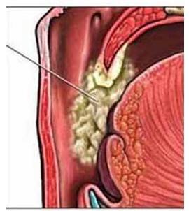 痰中带血究竟是怎么回事呢,痰中带血怎么回事中医