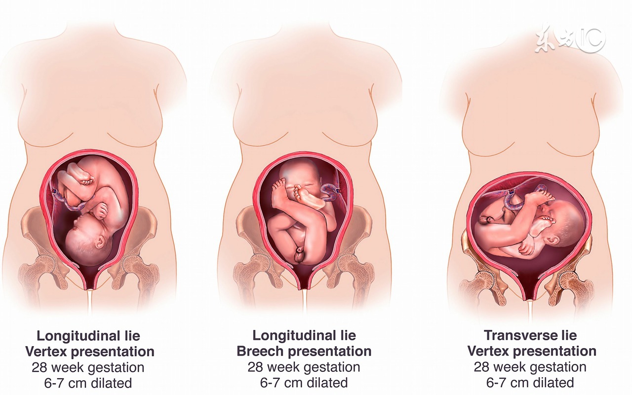 顺产产后伤口护理操作,顺产产后切口护理