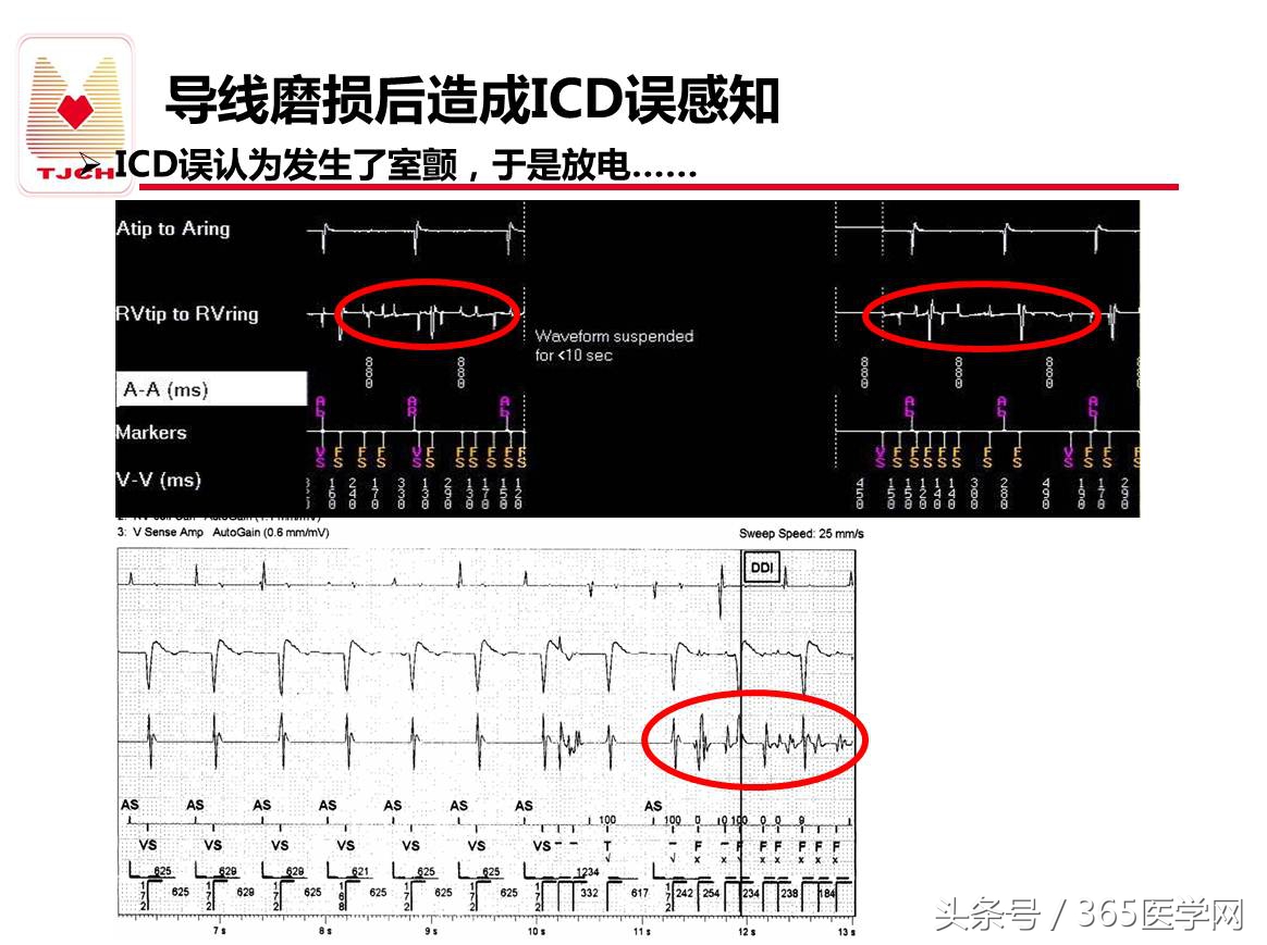 许静：新技术避免ICD不恰当放电