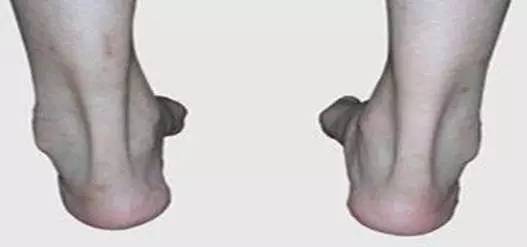 小腿结构图示图片,小腿骨骼构造示意图