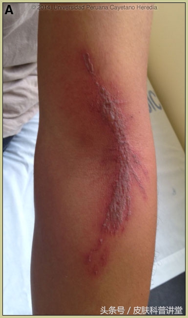 隐翅虫皮炎部位睡觉需要避开吗,晚上睡觉怎么避免隐翅虫