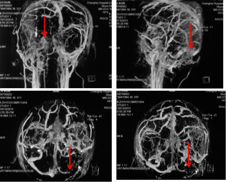 颅内静脉窦血栓怎么治疗,颅内静脉窦血栓造影多少钱