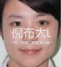 垫下巴鉴定,垫下巴看得出来吗