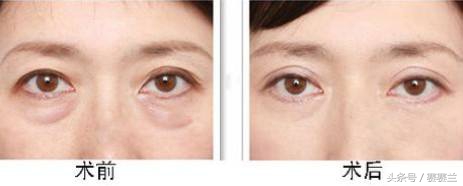 眼袋一笑就成卧蚕了是啥类型眼袋,什么样的眼袋是真正的眼袋