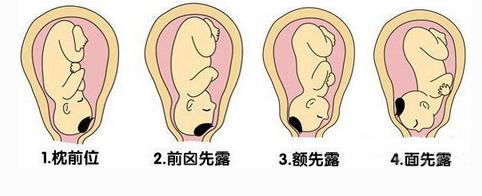 孕妇胎位不正医生使出乾坤大挪移,孕妇胎位不正医生手动转正胎位