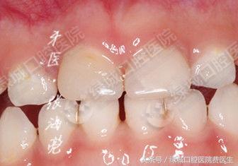 乳前牙透明冠修复大概要多久,乳前牙透明冠操作流程