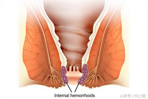 痔疮不管它有什么后果,痔疮患者需要了解的事
