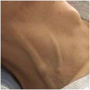 皮肤出现瘀斑是肝癌吗,皮肤上微凸的褐色斑是什么原因