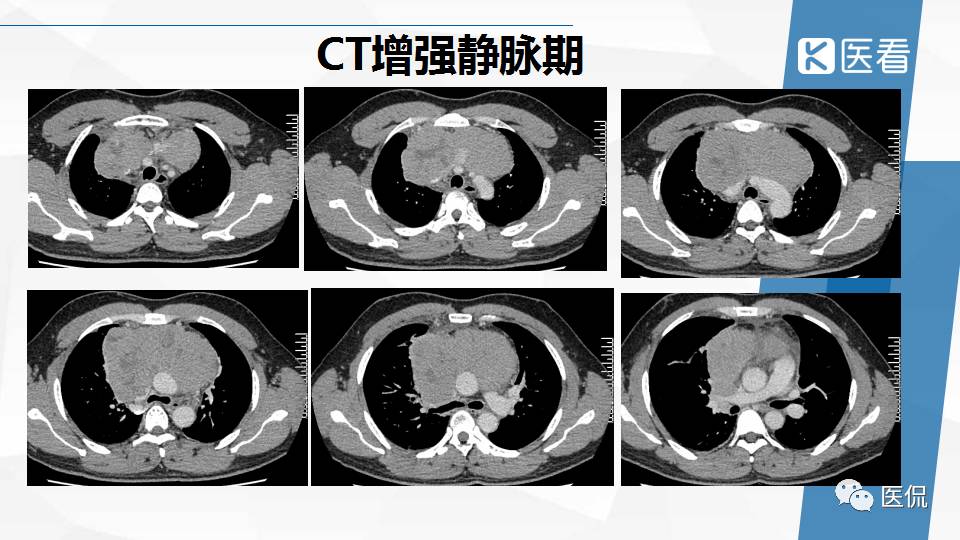 精原细胞瘤ct影像,精原细胞瘤影像特征