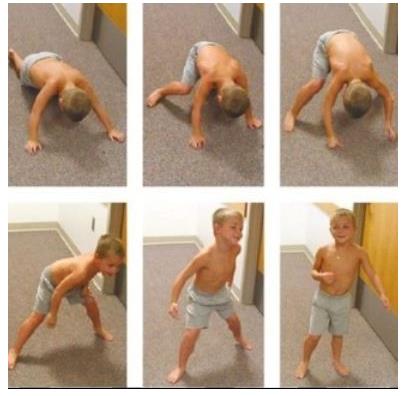 进行性肌营养不良症筛查,进行性肌营养不良问诊