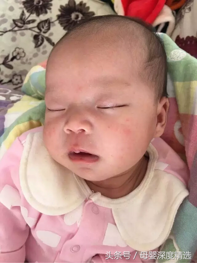 宝宝湿疹该如何有效护理,宝宝湿疹流脓结痂的部分怎么护理