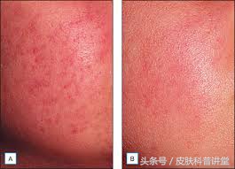 果酸焕肤精华液与果酸的区别,什么样的人需要果酸换肤