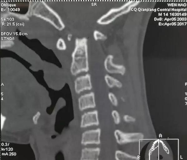 寰枢椎脱位手术适应症,寰枢椎脱位手术最广泛麻醉方法