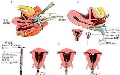 取环怎么取不受罪,取环的全流程痛苦不打麻醉