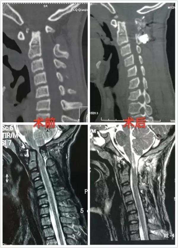 寰枢椎脱位手术适应症,寰枢椎脱位手术最广泛麻醉方法
