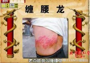 腰上长了一些水泡是不是蛇缠腰,腰上长了一圈小疙瘩是缠腰蛇么