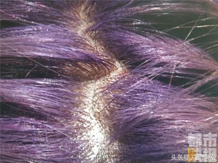 西安女子染了紫发头皮出血流脓店方承认操作不当