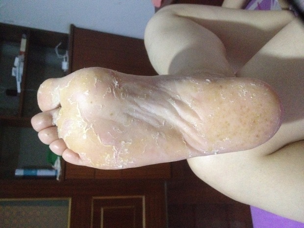 脚气无法治断根,脚气不止痒