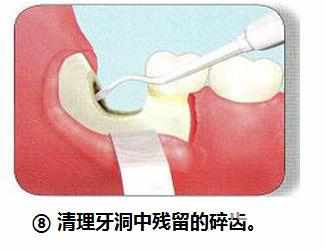 智齿横着长没露出来,智齿牙横着长怎么办