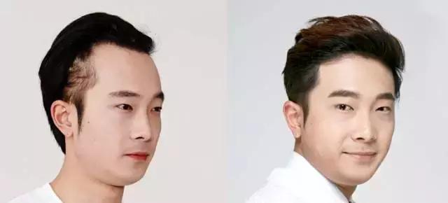 越来越多的男性整形,男士整容变帅案例