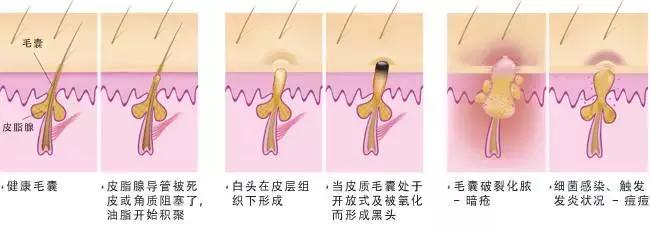 鼻头上的黑头越来越多是什么原因,一夜鼻头长了很多黑头是怎么了