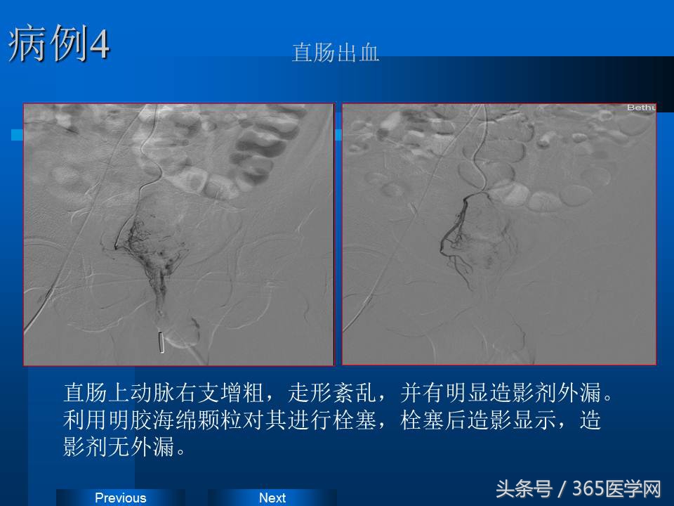崔进国：消化道出血的介入治疗