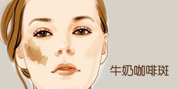 上海咖啡斑去除医院,上海新华医院看胎记怎么样
