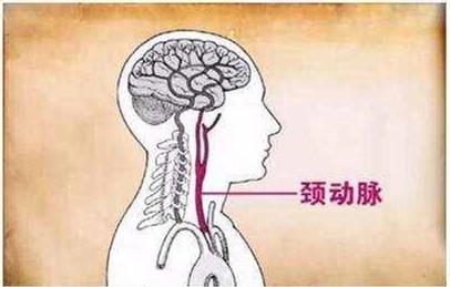 颈动脉斑块会引起脑中风吗,天生右颈动脉狭窄会导致脑中风吗
