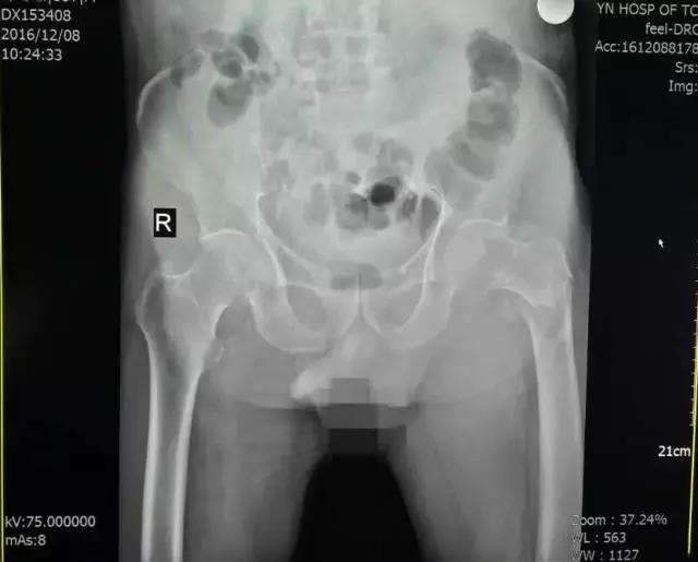 人生最后一次骨折保守治疗,髋部骨折又称人生最后一次骨折