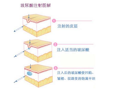 美容微整技术学习,微整变美逆袭攻略