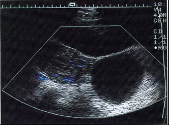 卵巢囊肿的b超描述,卵巢生理性囊肿的b超影像