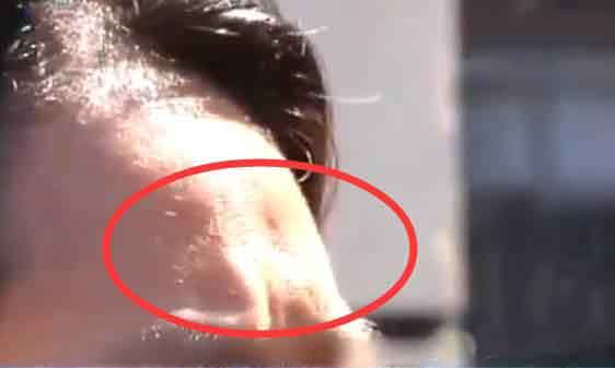 美版超声刀的副作用,做超声刀后有何副作用