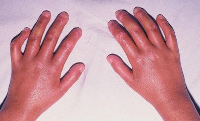 皮肤变硬的病,皮肤变硬就一定是硬皮病吗